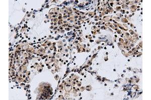 Immunohistochemical staining of paraffin-embedded Adenocarcinoma of Human breast tissue using anti-CBWD1 mouse monoclonal antibody. (CBWD1 抗体)