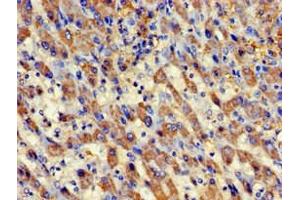Immunohistochemistry of paraffin-embedded human liver cancer using ABIN7145083 at dilution of 1:100 (Aurora Kinase C 抗体  (AA 12-143))
