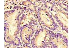 Immunohistochemistry of paraffin-embedded human colon cancer using ABIN7167611 at dilution of 1:100 (RGS4 抗体  (AA 1-205))