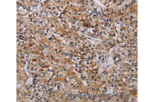 Immunohistochemistry of Human liver cancer using AATK Polyclonal Antibody at dilution of 1:45 (AATK 抗体)