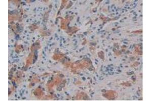 IHC-P analysis of Human Prostate Gland Cancer Tissue, with DAB staining. (Kallikrein 10 抗体  (AA 35-276))