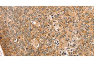 Immunohistochemistry of paraffin-embedded Human esophagus cancer using TRIM62 Polyclonal Antibody at dilution of 1:30 (TRIM62 抗体)