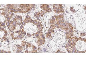ABIN6279304 at 1/100 staining Human liver cancer tissue by IHC-P. (CLDN14 抗体  (C-Term))