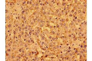 Immunohistochemistry of paraffin-embedded human liver cancer using ABIN7165807 at dilution of 1:100 (MENT (AA 24-197) 抗体)