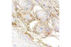 Immunohistochemistry of paraffin-embedded human esophageal cancer using Integrin-β1/CD29 Rabbit mAb (ABIN7267926) at dilution of 1:5000 (40x lens). (ITGB1 抗体)
