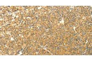 Immunohistochemistry of paraffin-embedded Human lymphoma using AARS2 Polyclonal Antibody at dilution of 1:40 (AARS2 抗体)