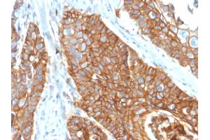 Formalin-fixed, paraffin-embedded human Cervical Carcinoma stained with CD9 Mouse Monoclonal Antibody (CD9/2343). (CD9 抗体)