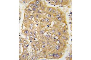 Formalin-fixed and paraffin-embedded human hepatocarcinoma tissue reacted with IGFBP3 Antibody (N-term) (ABIN391974 and ABIN2841768) , which was peroxidase-conjugated to the secondary antibody, followed by DAB staining. (IGFBP3 抗体  (N-Term))