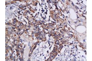 Formalin-fixed and paraffin embedded human colon carcinoma labeled with Anti-DAPK1 Polyclonal Antibody, Unconjugated  at 1:200 followed by conjugation to the secondary antibody and DAB staining (DAP Kinase 1 抗体  (AA 1331-1430))