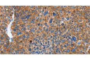 Immunohistochemistry of paraffin-embedded Human liver cancer using AUP1 Polyclonal Antibody at dilution of 1:50 (Ancient Ubiquitous Protein 1 抗体)