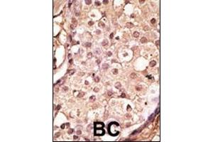 Formalin-fixed and paraffin-embedded human cancer tissue reacted with the primary antibody, which was peroxidase-conjugated to the secondary antibody, followed by AEC staining. (ACE2 抗体  (AA 140-172))