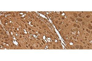Immunohistochemistry of paraffin-embedded Human esophagus cancer tissue using VCP Polyclonal Antibody at dilution of 1:30(x200) (VCP 抗体)