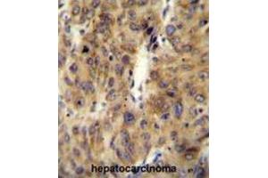 Immunohistochemistry (IHC) image for anti-APOBEC1 Complementation Factor (A1CF) antibody (ABIN2995767) (A1CF 抗体)