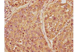 IHC image of ABIN7165036 diluted at 1:150 and staining in paraffin-embedded human liver cancer performed on a Leica BondTM system. (AMBP 抗体  (AA 20-203))