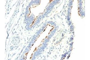 Formalin-fixed, paraffin-embedded human Colon Carcinoma stained with T-F Antigen / CD176 Mouse Monoclonal Antibody (A78-G/A7). (CD176 抗体)