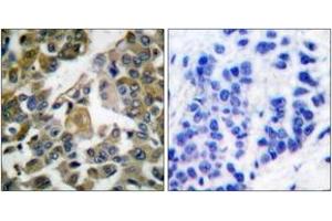 Immunohistochemistry analysis of paraffin-embedded human breast carcinoma tissue, using PLCG1 (Ab-783) Antibody. (Phospholipase C gamma 1 抗体  (AA 751-800))