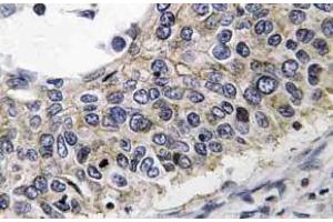Immunohistochemistry (IHC) analyzes of PRX III antibody in paraffin-embedded human lung carcinoma tissue. (Peroxiredoxin 3 抗体)