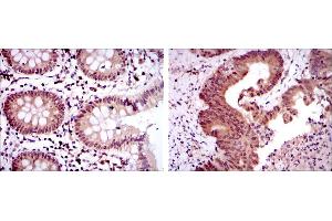 Immunohistochemical analysis of paraffin-embedded colon tissues (left) and colon cancer tissues (right) using OTX2 mouse mAb with DAB staining. (OTX2 抗体)