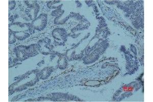 Immunohistochemical analysis of paraffin-embedded human colon caricnoma using Survivin Monoclonal Antibody. (Survivin 抗体)