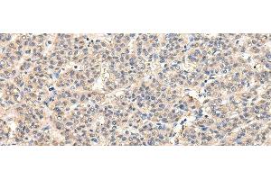 Immunohistochemistry of paraffin-embedded Human liver cancer tissue using VPS45 Polyclonal Antibody at dilution 1:50 (VPS45 抗体)