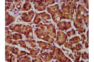 IHC image of ABIN7142134 diluted at 1:300 and staining in paraffin-embedded human pancreatic cancer performed on a Leica BondTM system. (MOGAT1 抗体  (AA 163-246))