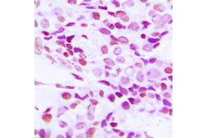 Immunohistochemical analysis of hnRNP G staining in human breast cancer formalin fixed paraffin embedded tissue section. (RBMX 抗体  (N-Term))