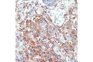 Immunohistochemistry of paraffin-embedded human breast cancer using Phospholipid Phospholipid Scramblase 1 (PLSCR1) (PLSCR1) Rabbit mAb (ABIN7269354) at dilution of 1:100 (40x lens). (PLSCR1 抗体)