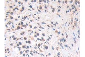 Detection of HLTF in Human Stomach cancer Tissue using Polyclonal Antibody to Helicase Like Transcription Factor (HLTF) (HLTF 抗体  (AA 837-996))