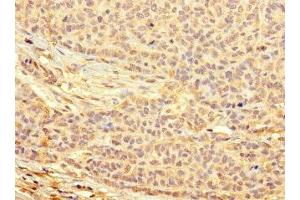 Immunohistochemistry of paraffin-embedded human ovarian cancer using ABIN7166432 at dilution of 1:100 (METTL21C 抗体  (AA 6-145))