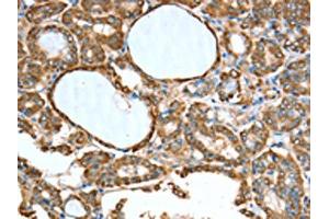 The image on the left is immunohistochemistry of paraffin-embedded Human thyroid cancer tissue using ABIN7189774(ALDH9A1 Antibody) at dilution 1/50, on the right is treated with synthetic peptide. (ALDH9A1 抗体)