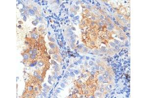 Immunohistochemistry of paraffin-embedded Human lung cancer using SEMA4C Polyclonal Antibody at dilution of 1:100 (40x lens). (SEMA4C 抗体)