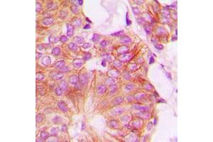 Immunohistochemical analysis of FHIT staining in human breast cancer formalin fixed paraffin embedded tissue section. (FHIT 抗体  (Center))