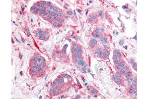 Anti-ERBB2 / HER2 antibody IHC of human breast carcinoma, neoplastic cells. (ErbB2/Her2 抗体  (Cytoplasmic Domain))