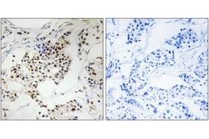 Immunohistochemistry analysis of paraffin-embedded human breast carcinoma, using SGOL2 Antibody.