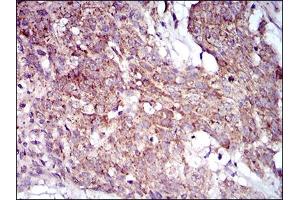 Immunohistochemical analysis of paraffin-embedded esophageal cancer tissues using MRPL42 mouse mAb with DAB staining. (MRPL42 抗体  (AA 142-203))