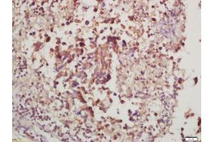 Formalin-fixed and paraffin embedded rat lung carcinoma labeled with Anti-phospho-P70 S6 Kinase beta (Thr228) Polyclonal Antibody, Unconjugated (ABIN732608) at 1:200, followed by conjugation to the secondary antibody and DAB staining (RPS6KB2 抗体  (pThr228))