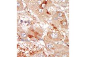 Formalin-fixed and paraffin-embedded human cancer tissue reacted with the primary antibody, which was peroxidase-conjugated to the secondary antibody, followed by DAB staining. (PRPF4B 抗体  (C-Term))