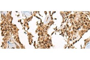 Immunohistochemistry of paraffin-embedded Human ovarian cancer tissue using ATE1 Polyclonal Antibody at dilution of 1:60(x200) (ATE1 抗体)