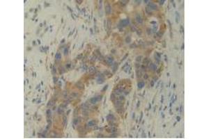 IHC-P analysis of Human Breast Cancer Tissue, with DAB staining. (IL12A 抗体  (AA 23-219))