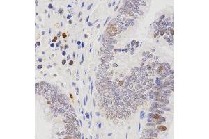 Immunohistochemistry of paraffin-embedded human rectal cancer tissue using SCTR antibody at dilution of 1:200 (x400 lens) (SCTR 抗体)