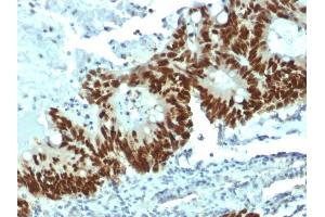 Formalin-fixed, paraffin-embedded human Colon Carcinoma stained with p53 Mouse Monoclonal Antibody (DO-1). (p53 抗体)