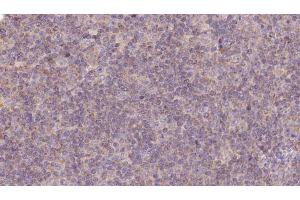 ABIN6273125 at 1/100 staining Human lymph cancer tissue by IHC-P. (HPS5 抗体  (Internal Region))
