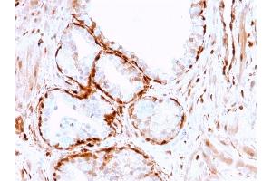 Formalin-fixed, paraffin-embedded human Prostate Tumor stained with AKR1B1 Mouse Monoclonal Antibody (CPTC-AKR1B1-3). (AKR1B1 抗体)