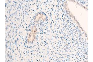 ABIN6267284 at 1/100 staining rat uterine cancer tissue sections by IHC-P. (ErbB2/Her2 抗体  (pTyr877))