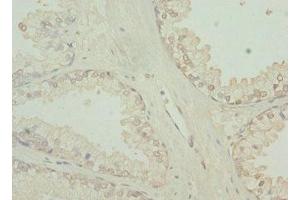 Immunohistochemistry of paraffin-embedded human prostate cancer using ABIN7173754 at dilution of 1:100 (TBCE 抗体  (AA 328-527))