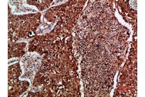 Immunohistochemical analysis of paraffin-embedded human-lung-cancer, antibody was diluted at 1:200 (IMP3 抗体  (AA 135-184))