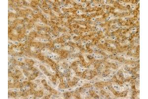 ABIN6256988 and ABIN6275146 at 1/100 staining human hepatocellular carcinoma by IHC-P.