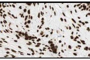 Affinity Purified anti-Gli2 antibody shows strong cytoplasmic and membranous staining of tumor cells in human breast tissue. (GLI2 抗体  (Internal Region))