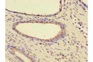 Immunohistochemistry of paraffin-embedded human prostate cancer using ABIN7170815 at dilution of 1:100 (HSPA9 抗体  (AA 458-679))