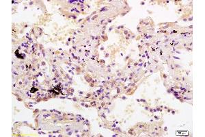 Formalin-fixed and paraffin embedded human lung carcinoma labeled with Rabbit Anti SDHC Polyclonal Antibody, Unconjugated (ABIN1385318) at 1:200 followed by conjugation to the secondary antibody and DAB staining (SDHC 抗体  (AA 81-169))